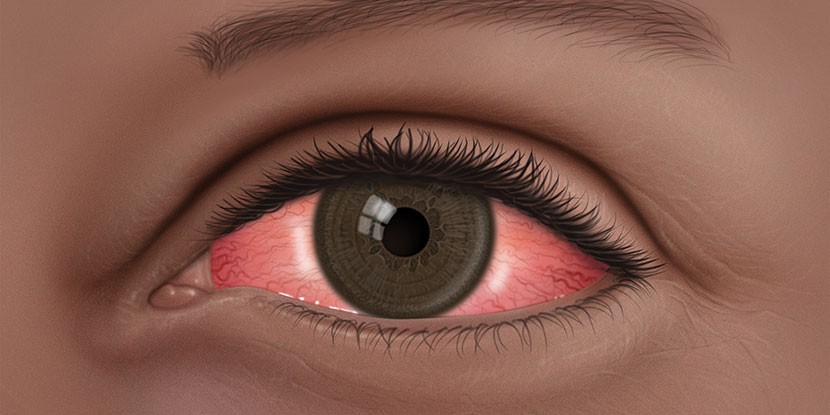 Neurología: Edema cerebral postraumático, edema causado por tumores cerebrales.

Oftalmología: Conjuntivitis alérgica, neuritis óptica, iridociclitis.

Reumatología: Artritis reumatoide, gotosa, postraumá­tica, osteoartritis, sinovitis, bursitis, espondilitis anquilosante, lupus eritematoso sistémico y en la epicondilitis (intraarticular) 

vía INTRALESIONAL en lesiones queloides, inflamatorias, infiltrados hipertróficos de liquen plano, lupus discoide, alopecia areata.