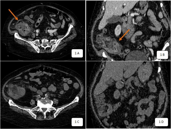  En los tratamientos prolongados es conveniente practicar en forma regular biometrías hemáticas.

Cuando se presenta diarrea posiblemente por colitis pseudomembranosa debido al sobrecrecimiento de Clostridium difficile.

En  insuficiencia hepática y renal se debe reducir la dosis.

Se deberá evitar la aplicación IM con la solución intravenosa (es dolorosa)

En raras ocasiones se han observado imágenes sugestivas de sedimentos biliares con la ultrasonografía. 

En los pacientes diabéticos pueden producirse reacciones falso-positivas para los análisis de glucosa en orina que utilizan sulfato de cobre.