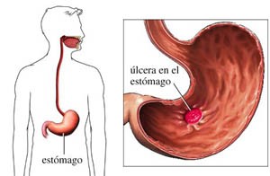 Con la administración sistémica con aminoglucósidos ha tenido una actividad antibacteriana aditiva o sinérgica, al igual que con antibióticos beta lactámicos. 

En combinación con anticoagulantes cumarínicos ocasiona un aumento en el tiempo de protrombina y hematemesis. 

En conjunto con teofilina ocasiona concentraciones séricas de teofilina más altas y prolongadas