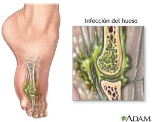 Levofloxacino está indicado para el tratamiento de infecciones osteoarticulares como 

*Osteomielitis
*Infecciones intraabdominales
* Infecciones del tracto genitourinario ( prostatitis crónica bacteriana y pielonefritis, uretritis gonocócica)
*Neumonías adquiridas en la comunidad y en el ámbito hospitalario
*Exacerbación aguda de bronquitis crónica
* Infecciones de piel y tejidos blandos, sinusitis aguda